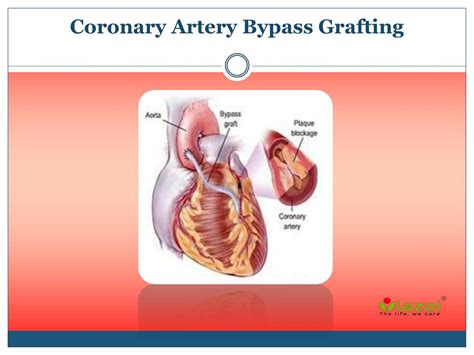 PPT - Coronary Artery Bypass Grafting PowerPoint Presentation, free ...