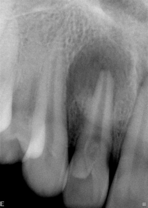 Dens in Dente 2, Endodontics Conroe TX Ellis Endodontics