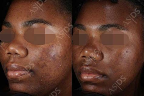 Post Inflammatory Hyperpigmentation Reddit : Pigmentation Dermal Skin Deep Tx Plano ...