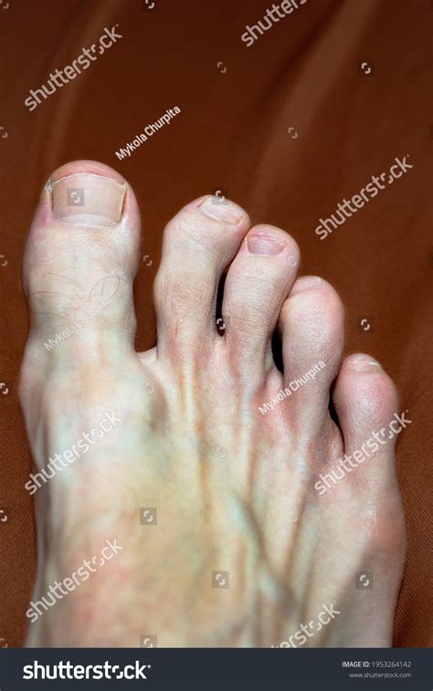 Osteophytes On Fingers Toes Known Asâ Stock Photo 1953264142 | Shutterstock