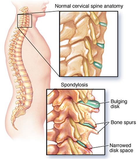 Spondylosis: Causes, Prevention and Treatment