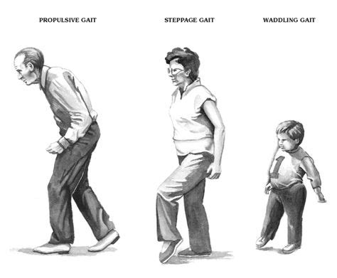 Propulsive Gait - Steppage Gait - Waddling Gait | FOOT | Pinterest ...