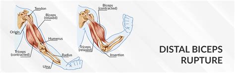 Distal Biceps Rupture - Dr. Saurabh Aggarwal