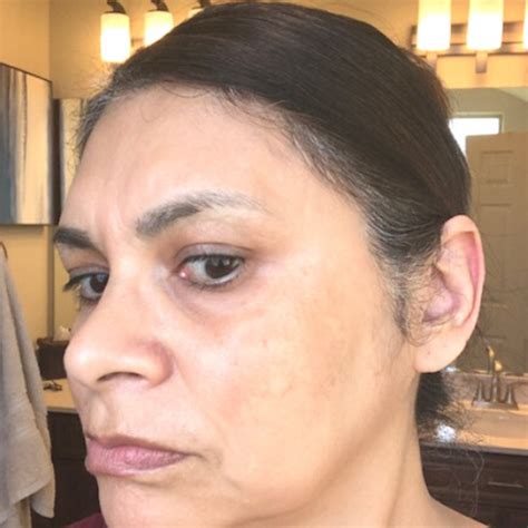 MELASMA TREATMENT BEFORE AND AFTER PHOTOS – GSC BB