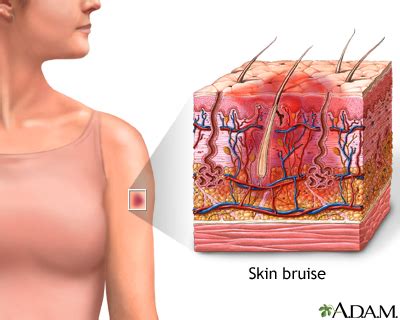 Bruise Information | Mount Sinai - New York