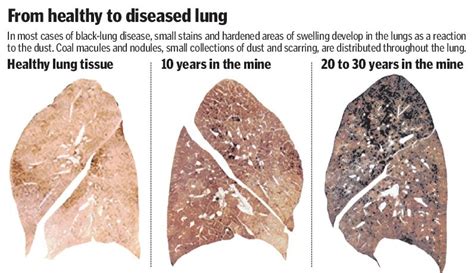 What Causes Black Lung Disease In Smokers