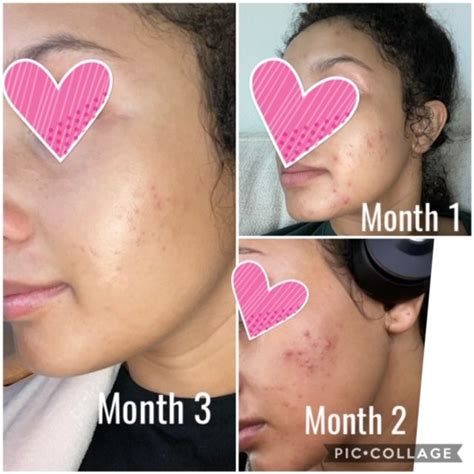 adapalene making acne worse - Lillian Hart
