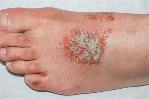 Eczema Blisters: Symptoms, Location, and Treatment