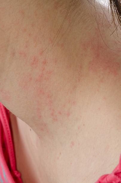 Psoriasis On Neck Stock Photos, Pictures & Royalty-Free Images - iStock