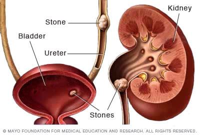 Kidney stones - Symptoms and causes (2023)