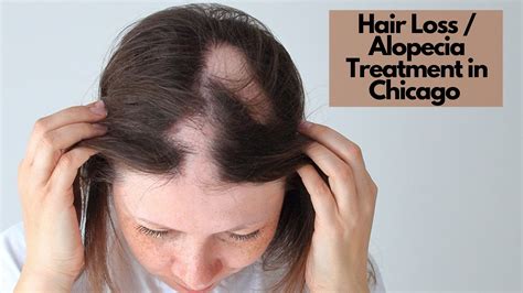 Hair Loss / Alopecia - Kovak Cosmetic Center Chicago Illinois