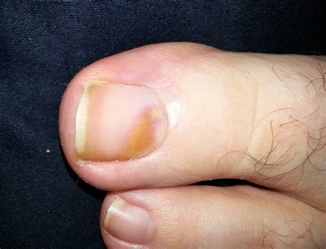 black spot under toenail melanoma Car Pictures