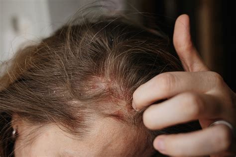 Head Lice: Symptoms, Causes & Diagnosis | LiceDoctors | LiceDoctors