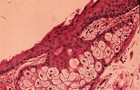 Steatocystoma Multiplex Histology