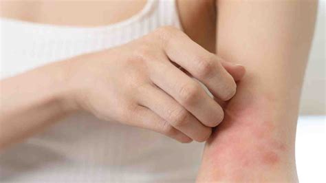 Heat rash treatment: Try the cooling benefits of coconut oil | HealthShots