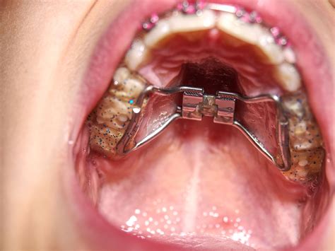 Palatal Expanders FAQ - Everything You Need to Know