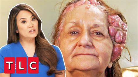 Woman Has Over 100 Cysts On Her Head | Dr Pimple Popper This Is Zit ...