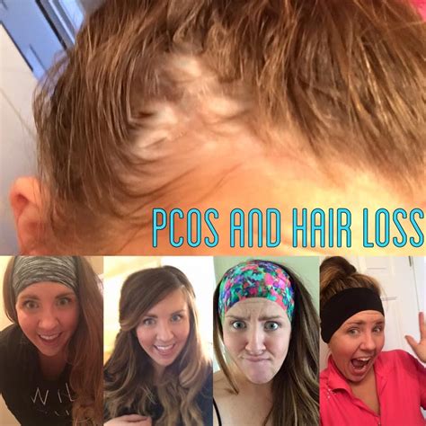 How To Control Hair Fall In Pcos Naturally Tips And Tricks - Best ...