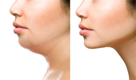 How to Get Rid of Excess Chin Fat With Kybella - Dontage