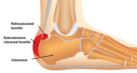 Subcutaneous Calcaneal Bursitis