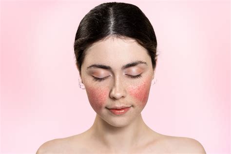 Rosacea Symptoms | Pinnacle Dermatology | Beaufort, SC