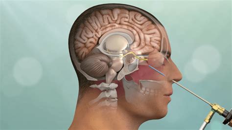 Pituitary Adenoma Videos - Pacific Neuroscience Institute