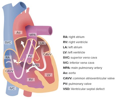 Atrioventricular Septal Defect (AVSD) | Concise Medical Knowledge