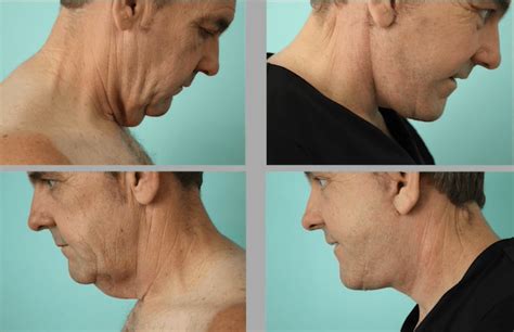 Best Neck Lift Surgery in Mexico | VIDA Wellness and Beauty