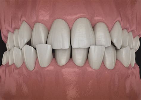 Crossbite Correction with Invisalign | Top Stamford Dentistry