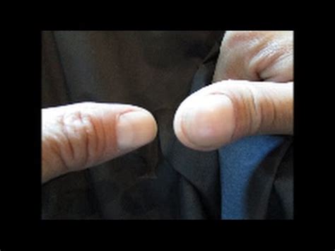thumb tumor thumb surgery swollen thumb - YouTube