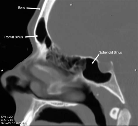 Chronic Sinusitis Information - Nasal & Sinus Center - Dr. Goyal