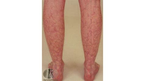 Mottled Skin (Livedo Reticularis): Causes, Signs, and Treatment