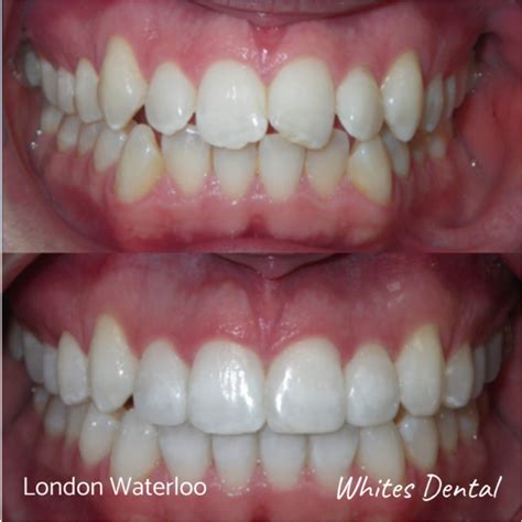 Fixed Braces Before And After | Orthodontist | Whites Dental