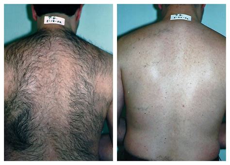 Laser Hair Removal for Men in Pittsburgh - Happel Laser Spa