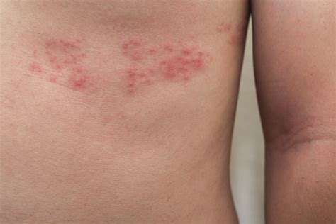What is Shingles? - Beaumont Emergency Hospital