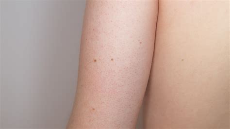 Keratosis Pilaris: Diagnosis, Causes, & Treatment - Toronto Dermatology Centre