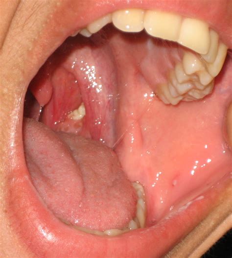 Tonsil stones - Wikipedia