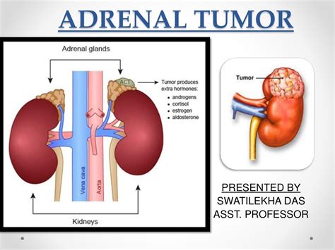 Adrenal tumor, classification, management - easy explanation