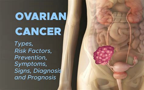 Ovarian Cancer: Introduction – EndoGynecology