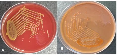 Chryseobacterium Bloodstream Infection in a Case of Non-Hodgkins Lymphoma: An Emerging Pathogen ...