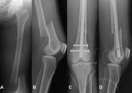 Fractura extremitatii distale a femurului