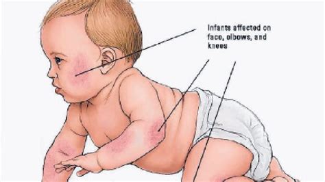 Baby eczema: tips on what to expect and how to control it - The Citizen