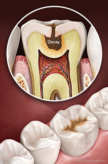 Tooth Decay Prevention in Sugar Land, Richmond & Rosenberg