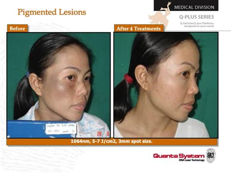 Melasma Treatment San Francisco: Cost, Risks, Before & After