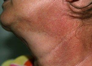 Poikiloderma civatte is a skin condition that caused by the sun ...