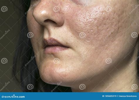 Acne Scars On The Face Royalty-Free Stock Photo | CartoonDealer.com ...