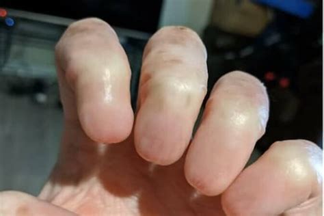 Viral Photo of Hand Without Fingernails Leaves Internet in Disbelief ...