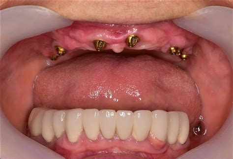 Fixed Implant Denture - Athens, GA | Watkinsville, GA — Hall Dental