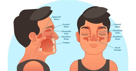 What happens if nasal polyps go untreated?