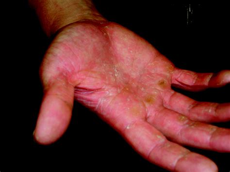 [36+] Eczema Treatment For Hands